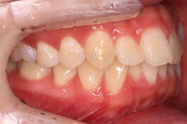 부산비대칭교정