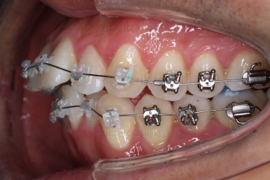 부산교정치과추천