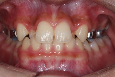 부산비발치교정