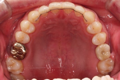 연산동임플란트