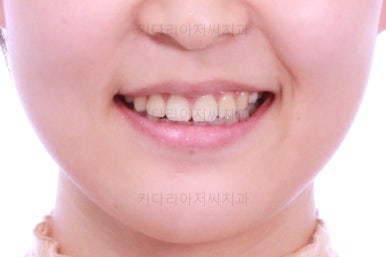 부산클리피씨교정