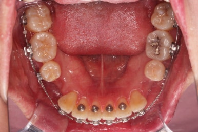 부산치아교정잘하는치과