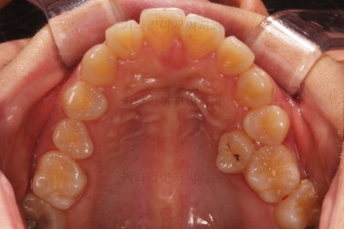 부산연산동교정치과