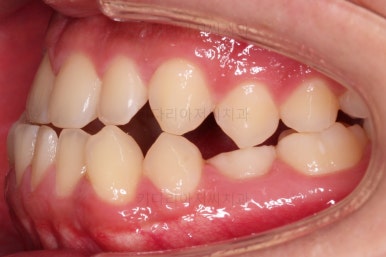 부산주걱턱교정