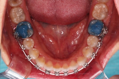 부산구순구개열