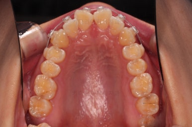 부산앞니부분교정