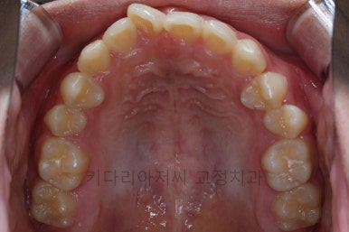 연산동치아교정