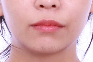 부산사랑니교정