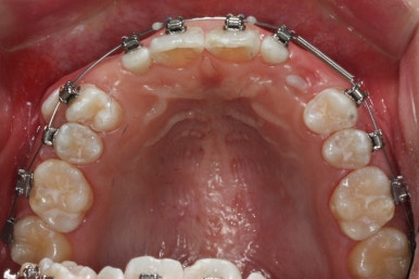 부산왜소치교정