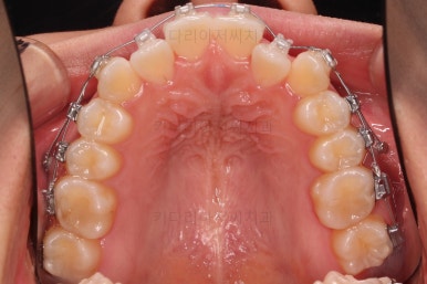 부산비발치교정