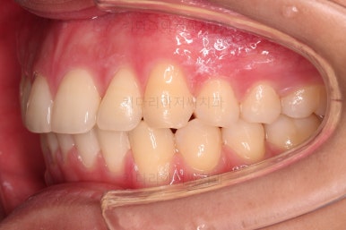 부산연산동치아교정