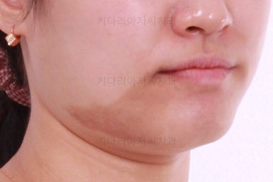 부산치아교정잘하는곳