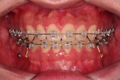 부산주걱턱교정