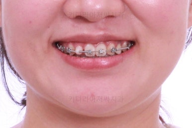 부산치아교정치과