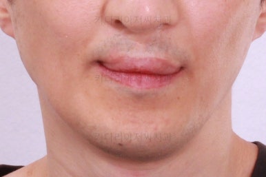 부산구순구개열교정