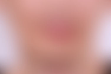 부산구순구개열교정