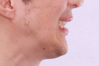 부산구순구개열교정