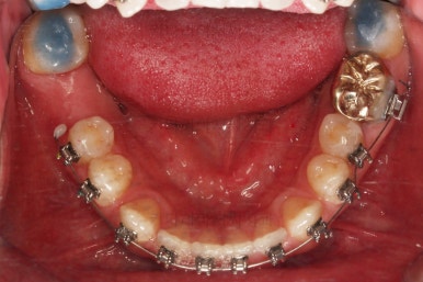 연산동임플란트