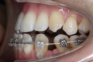 부산비수술교정