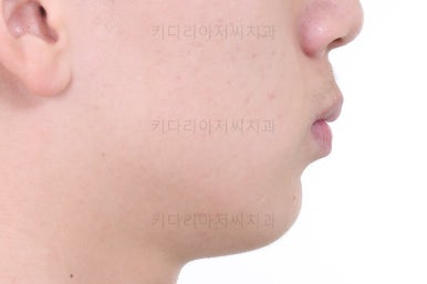 부산청소년치아교정