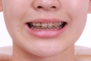 부산연산동치아교정