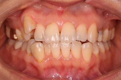 부산인비절라인