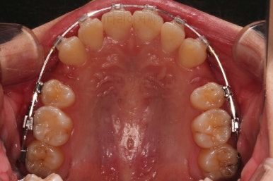 부산돌출입교정