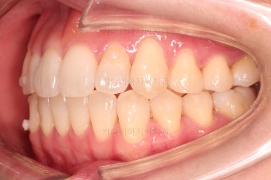 부산인비절라인