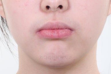 부산투명교정