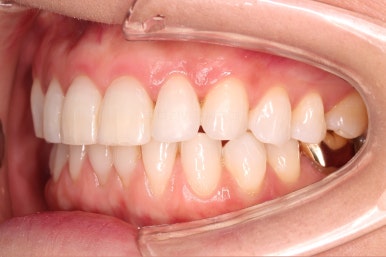 연산동부분교정