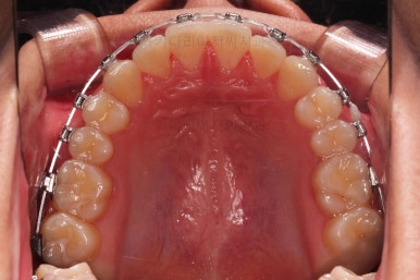 부산연산동치아교정