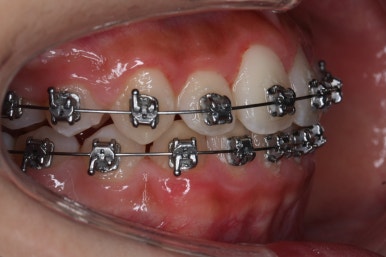 부산비발치교정