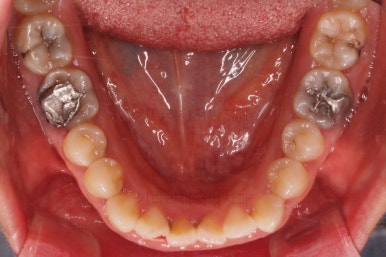 부산구순구개열
