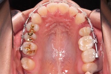 부산사랑니교정