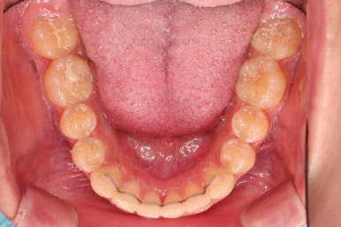 부산비발치교정