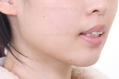 부산클리피씨교정