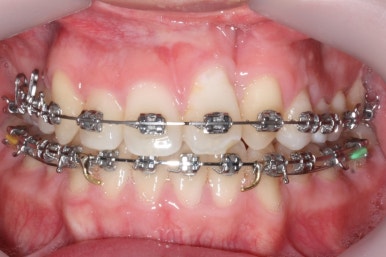 부산구순구개열