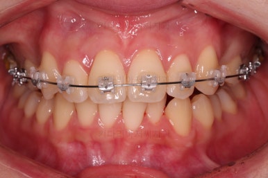 부산돌출입교정