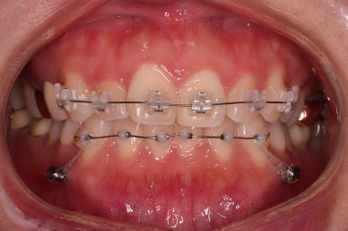 부산부분치아교정