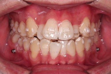 부산인비절라인