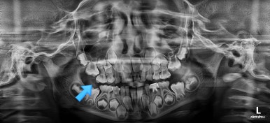 부산어린이치아교정