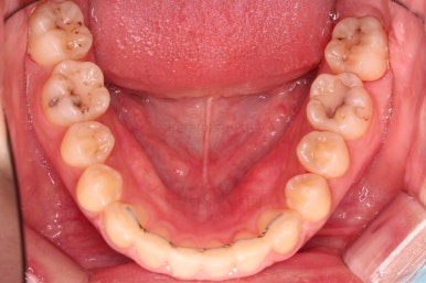부산돌출입교정