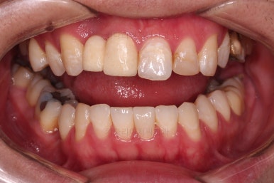 연산동치아교정