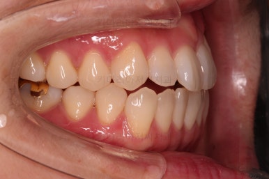 부산인비절라인