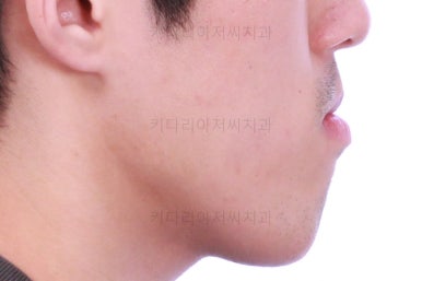 부산긴얼굴긴턱교정