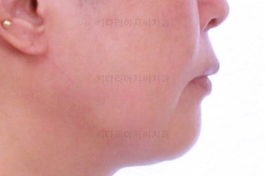 동래임플란트교정