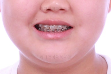 부산교정치과추천