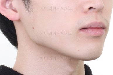 부산돌출입교정