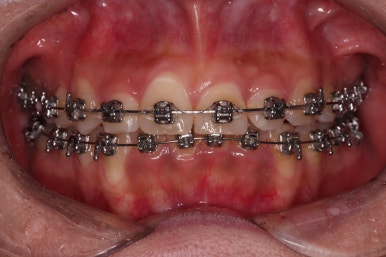 부산안면비대칭