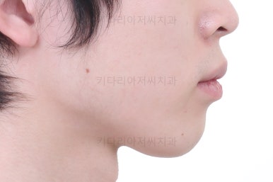 부산돌출입교정